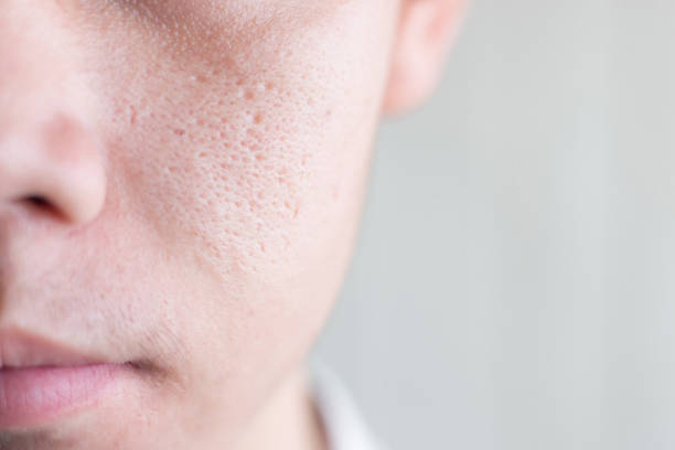 15 Home Remedies for Pores That Aren’t Closing